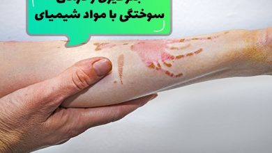 روش های درمان زخم سوختگی شیمیایی