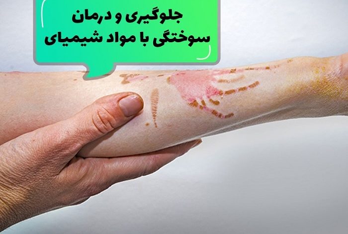 روش های درمان زخم سوختگی شیمیایی