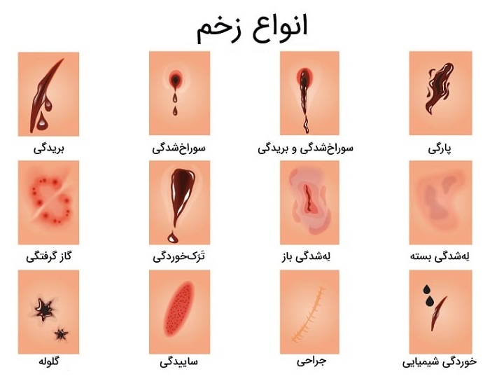 پانسمان زخم چگونه انجام میشود | انواع زخم و درمان مناسب آن