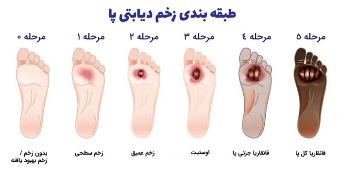 طبقه بندی انواع زخم پای دیابتی