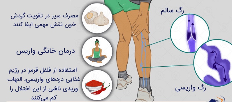 زخم واریس چیست و چگونه درمان میشود