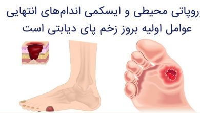 نوروپاتی محیطی ناشی از دیابت