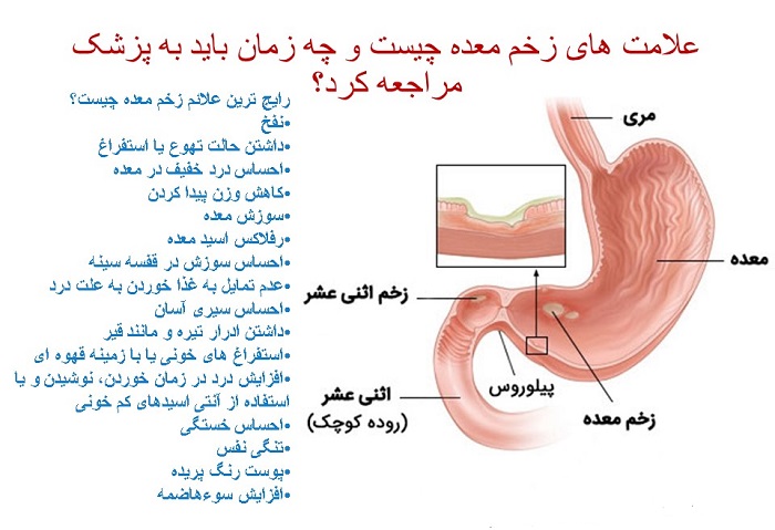 درد اثنی عشر / زخم دوازدهه / زخم دئودنوم کجاست؟