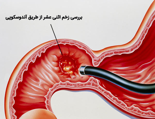 بررسی زخم اثنی عشر از طریق آندوسکوپی