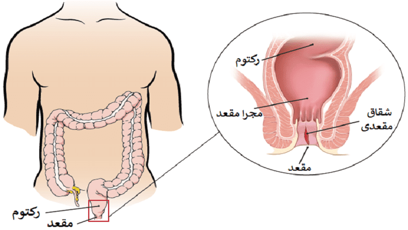 نحوه تشخیص و درمان زخم مقعدی چگونه است