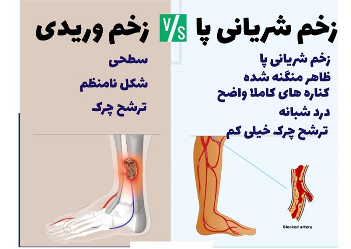 تشخیص و درمان زخم وریدی چگونه انجام میشود