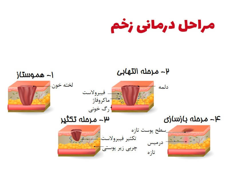 روش های درمانی برای زخم های مزمن چگونه است