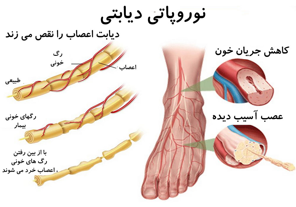 علل بیماری نوروپاتی دیابتی و جلوگیری از پیشرفت آن