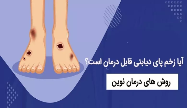 کاربرد لیزر درمانی در درمان پای دیابتی