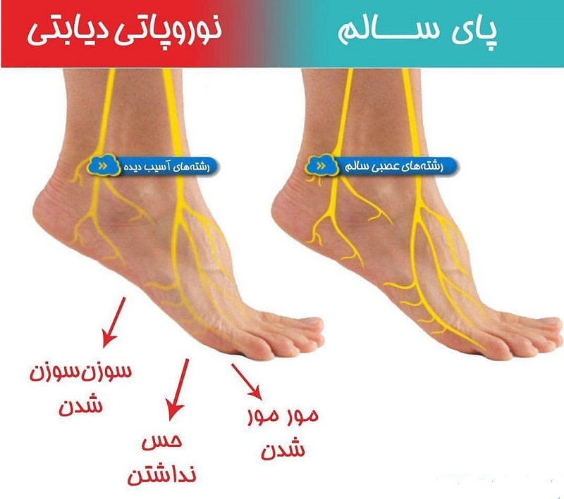 نوروپاتی دیابتی و روش های درمان آن 