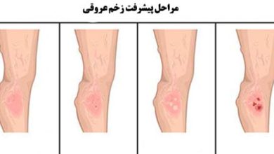 چگونه زخم عروقی تشخیص داده می شود؟