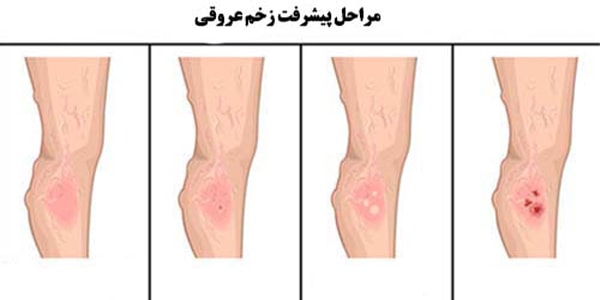 چگونه زخم عروقی تشخیص داده می شود؟