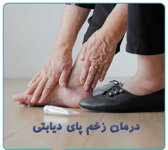 درمان زخم دیابتی توسط پزشک متخصص