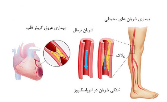 آیا زخم های عروقی قابل درمان هستند؟