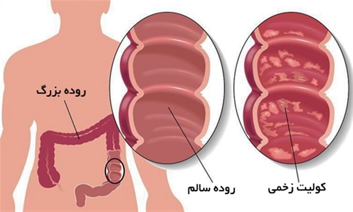 زخم روده چیست و چگونه درمان میشود