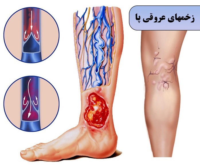 زخم عروقی و روش های درمان آن