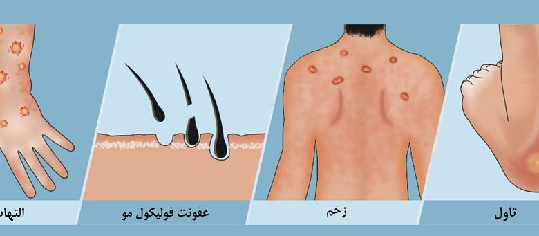 زخم پوستی چه علائمی دارد