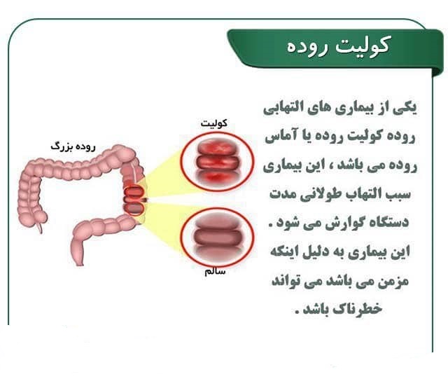 کولیت روده چیست و چه علائمی دارد