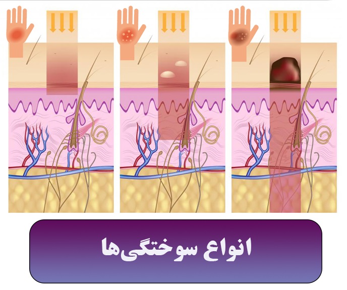 انواع زخم سوختگی کدامند