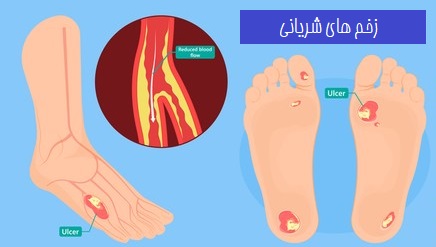 زخم شریانی چگونه تشخیص داده می شود؟