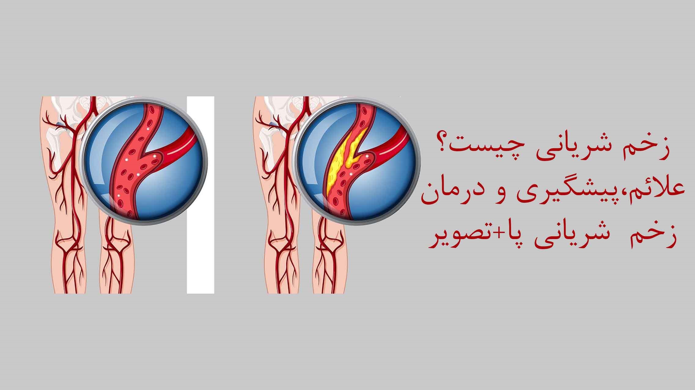 زخم شریانی و راه های درمان آن