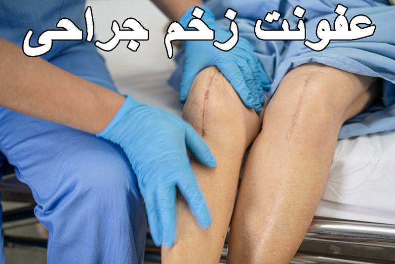 عفونت زخم جراحی چگونه درمان میشود