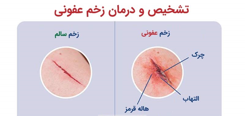 عفونت زخم چیست و چگونه درمان میشود