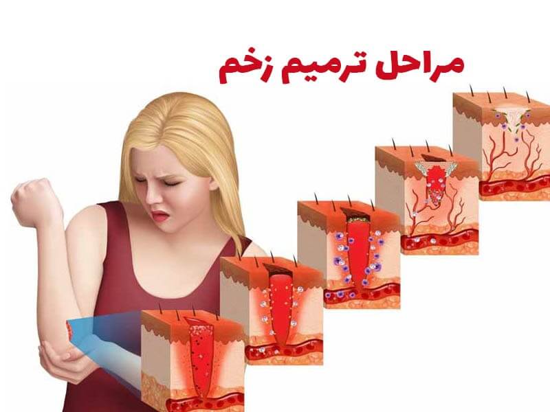 ترمیم زخم سوختگی چه مراحلی دارد