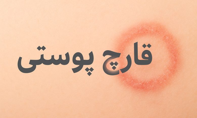 قارچ پوستی