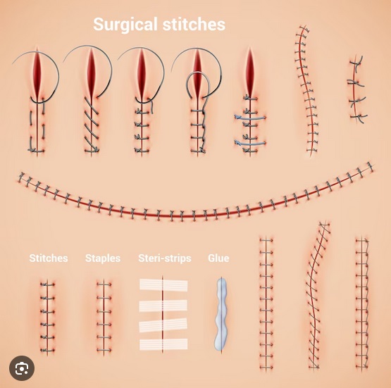 انواع بخیه جراحی کدامند