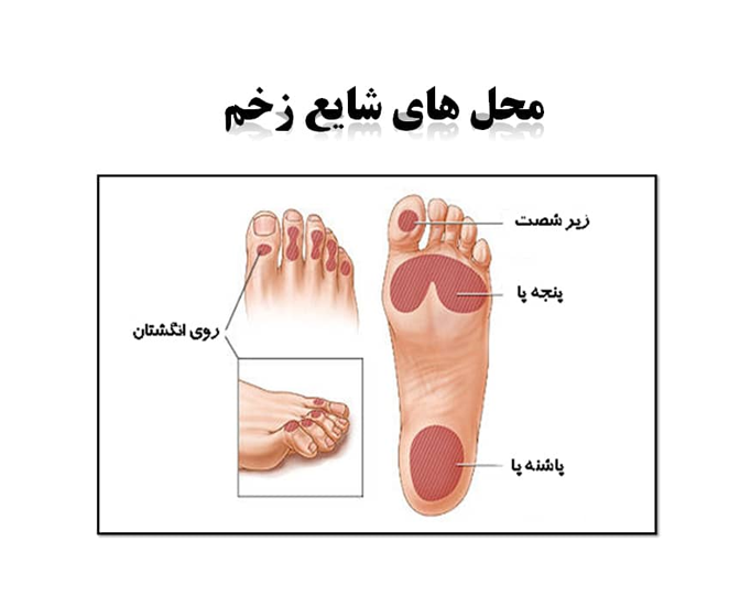 زخم روی پا دارای چه علائمی است