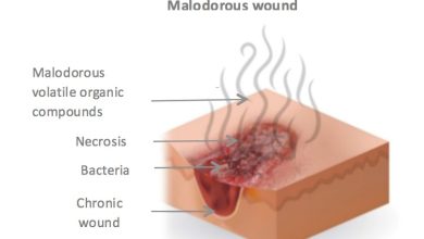 درمان بوی بد زخم چگونه است