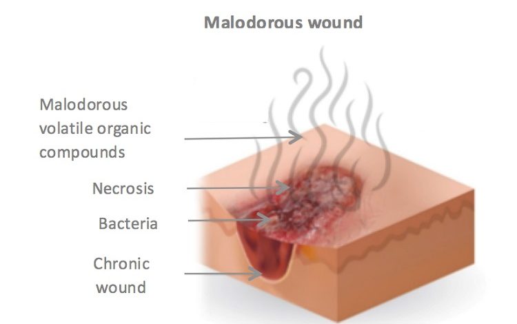 درمان بوی بد زخم چگونه است