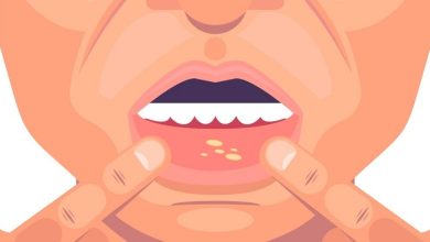 زخم دهان چه عوارضی دارد