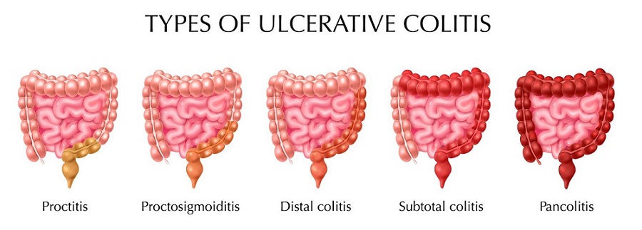 انواع کولیت روده کدامند