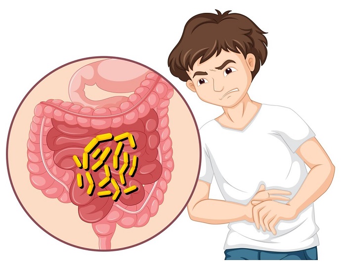 عوارض احتمالی کولیت اولسراتیو چیست