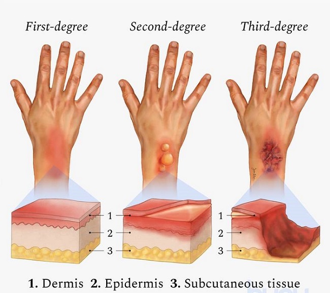 انواع عفونت سوختگی کدامند