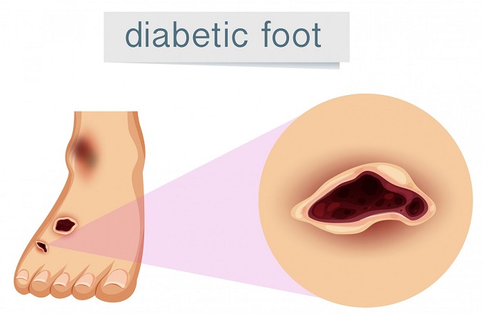 عفونت پای دیابتی چیست
