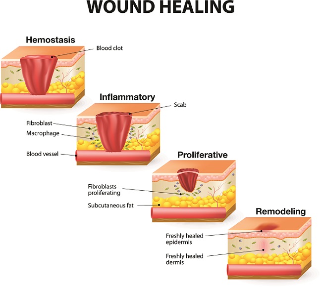 مراحل ترمیم زخم شامل چه مواردی میشود