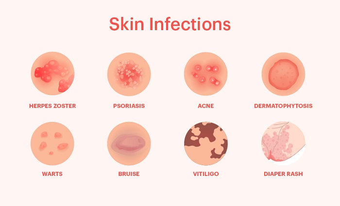 عفونت پوستی چیست و چگونه بوجود می آید
