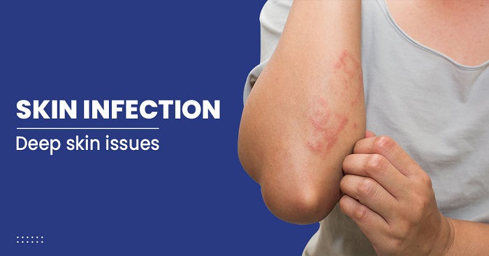 عفونت پوستی چه علائمی دارد