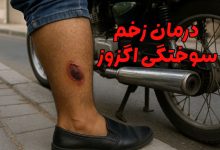 درمان زخم سوختگی اگزوز