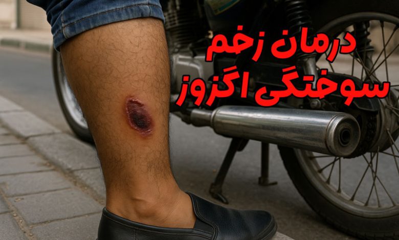 درمان زخم سوختگی اگزوز