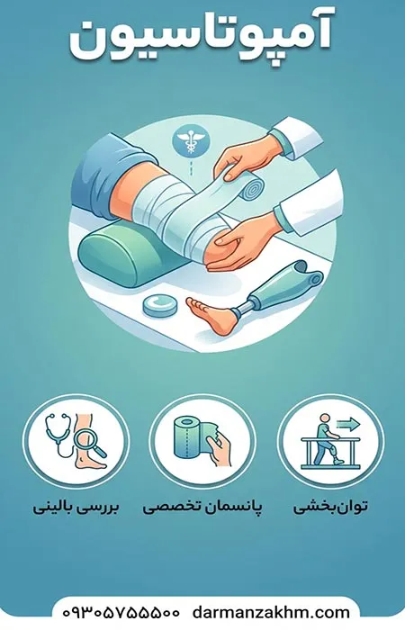آمپوتاسیون یا آمپوته