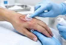 بهترین پماد سوختگی
