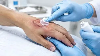 بهترین پماد سوختگی