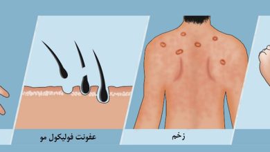 زخم پوستی چه علائمی دارد