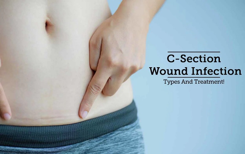 هزینه درمان عفونت سزارین