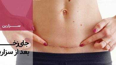 عفونت بخیه سزارین چگونه انجام میشود