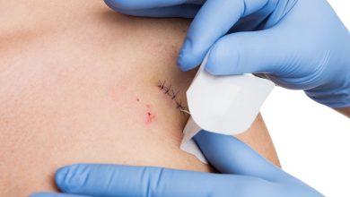 بخیه چیست و چگونه انجام میشود